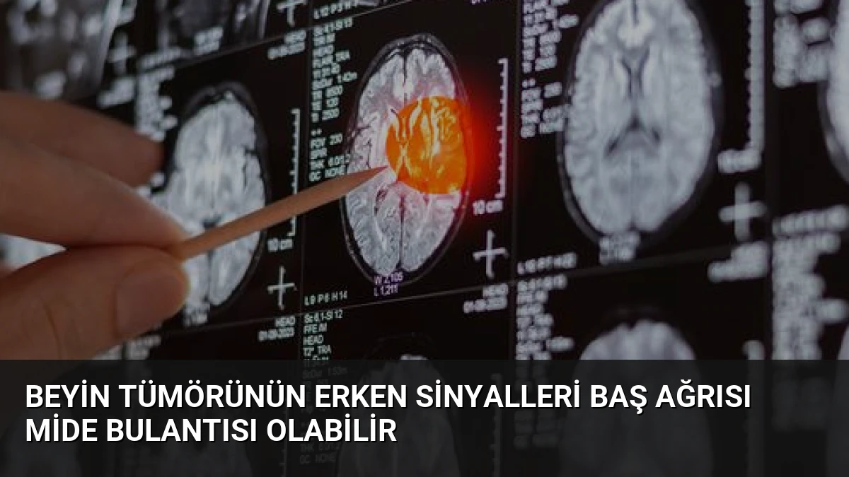 Beyin Tümörünün Erken Sinyalleri Baş Ağrısı Mide Bulantısı Olabilir